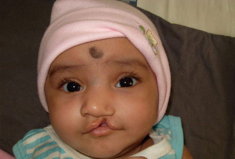 Bhargavi as a baby before cleft surgery