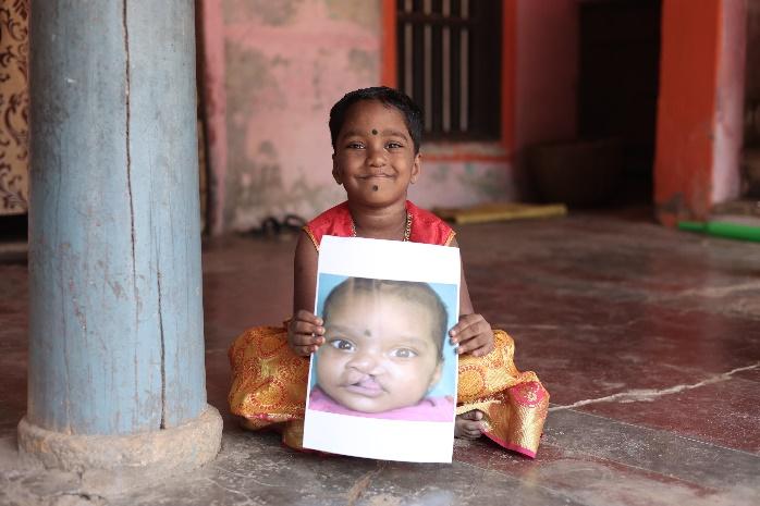 Ajantha smiling and holding a picture of herself before cleft surgery
