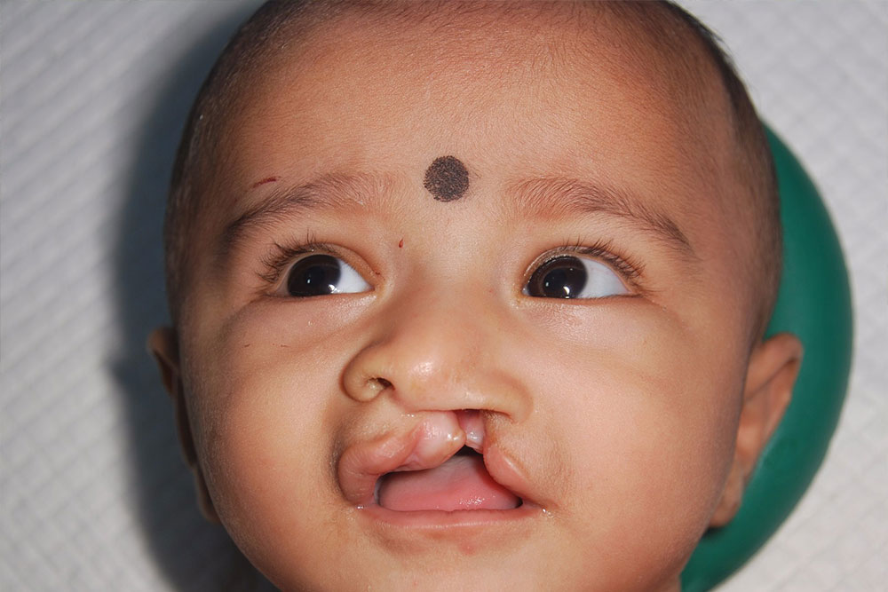 Manthan as a baby before cleft surgery