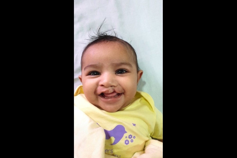 Sakshi smiling before cleft surgery