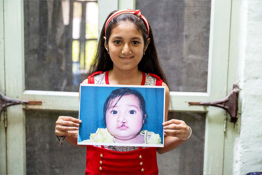 Angel holds up a photo of herself before cleft treatment