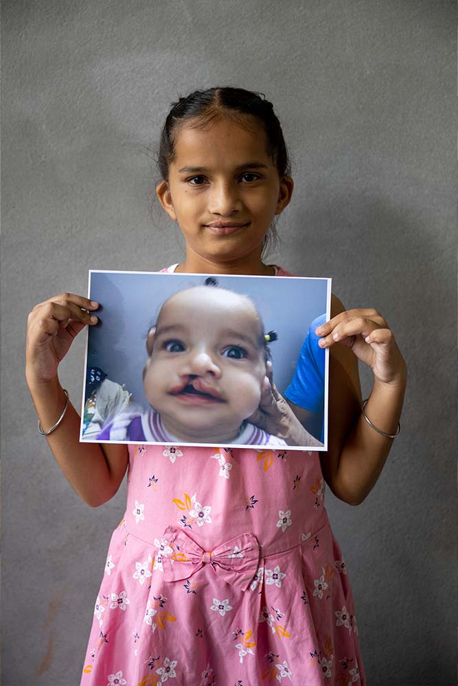 Hargun holds up a photo of herself from before cleft treatment