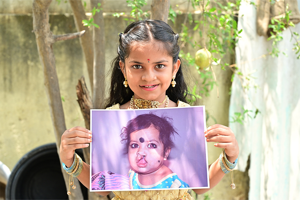 Pravallika smiling and holding a picture of herself before cleft surgery