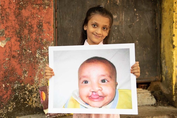 girl holds up image of herself before cleft lip surgery