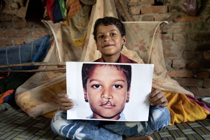 Shubham smiling and holding a photo of himself before cleft surgery
