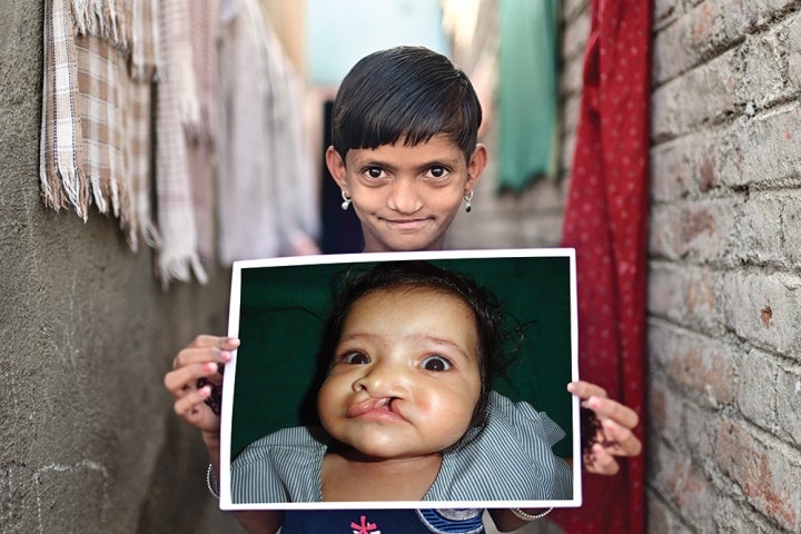 Yashoda smiling and holding a picture of herself before cleft surgery
