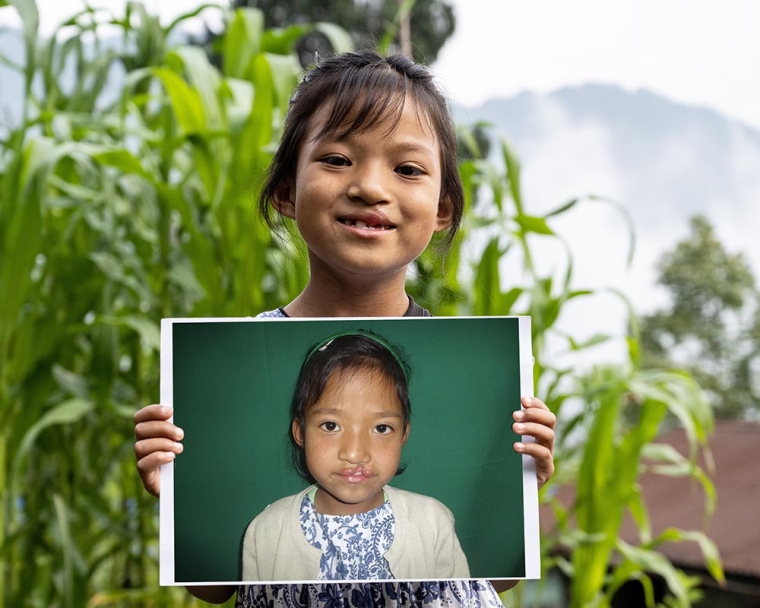 Girl hold image of himself before cleft lip surgery