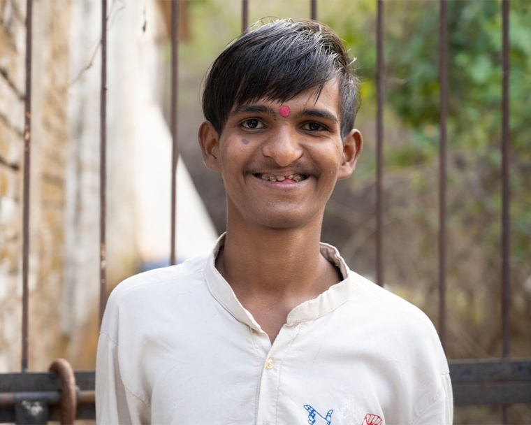 Sujal smiling after cleft surgery